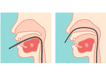 胃カメラ検査は口・鼻から選択可能